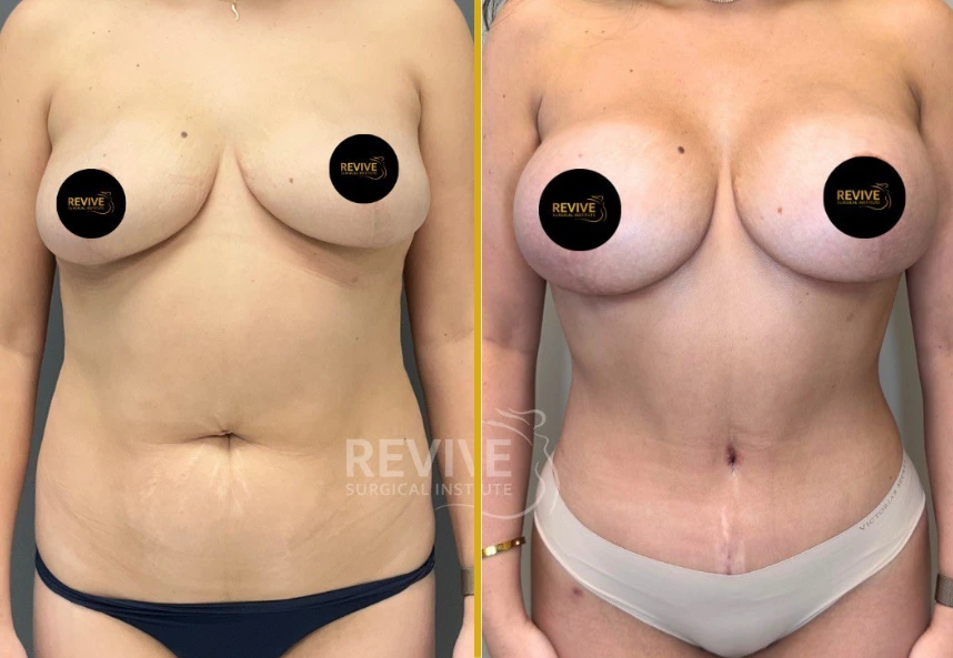 Before and After Gallery: Mommy Makeover