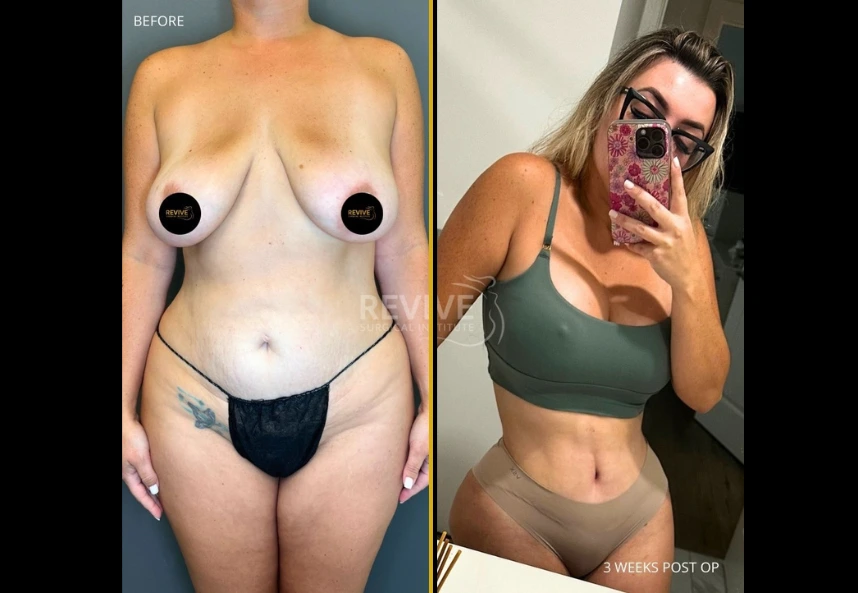 Before and After Gallery: Mommy Makeover