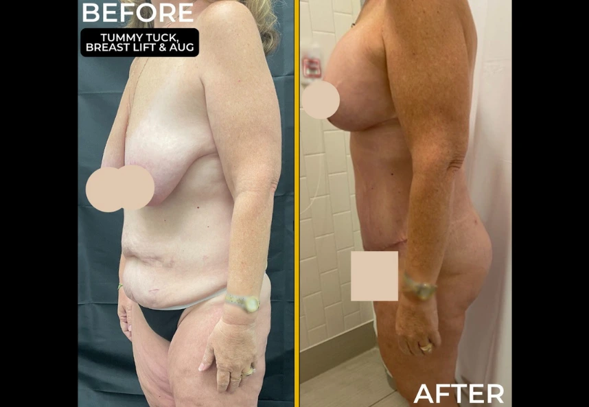 Before and After Gallery: Mommy Makeover