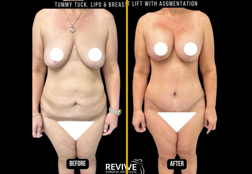 Before and After Gallery: Mommy Makeover