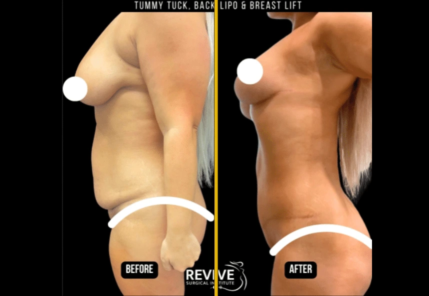 Before and After Gallery: Mommy Makeover