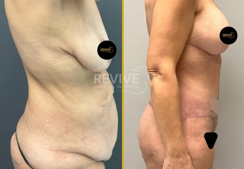 Before and After Gallery: Tummy Tuck