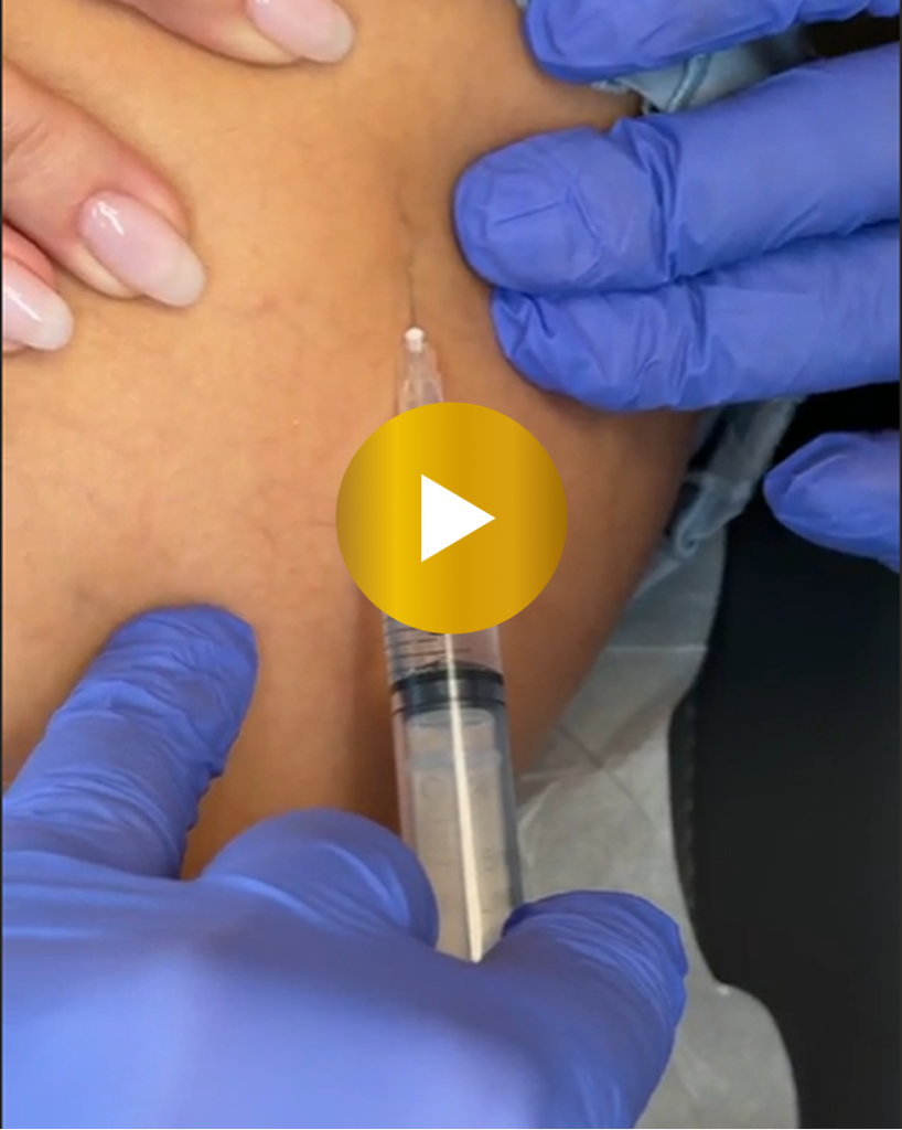 Spider Vein Removal in Miami, Florida Banner