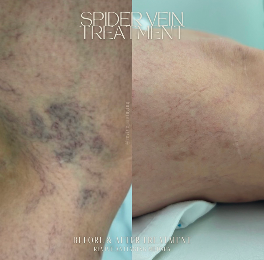 Spider Vein Therapy in Miami, FL Banner