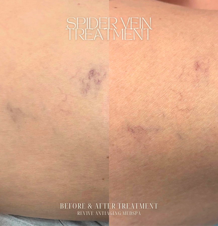 Spider Vein Treatment Miami, FL Banner