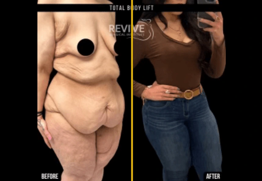 Before and After Gallery: Skin Tightening